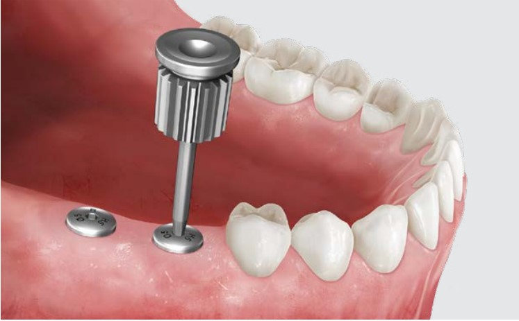 Implant Healing Scan Body — product shot