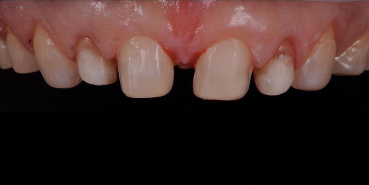 Anterior Full Zirconia — Before (1)
