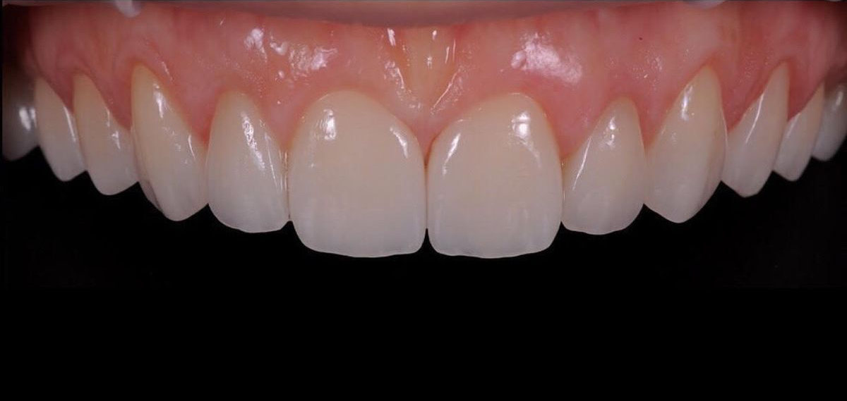 Anterior Full Zirconia — After (1)
