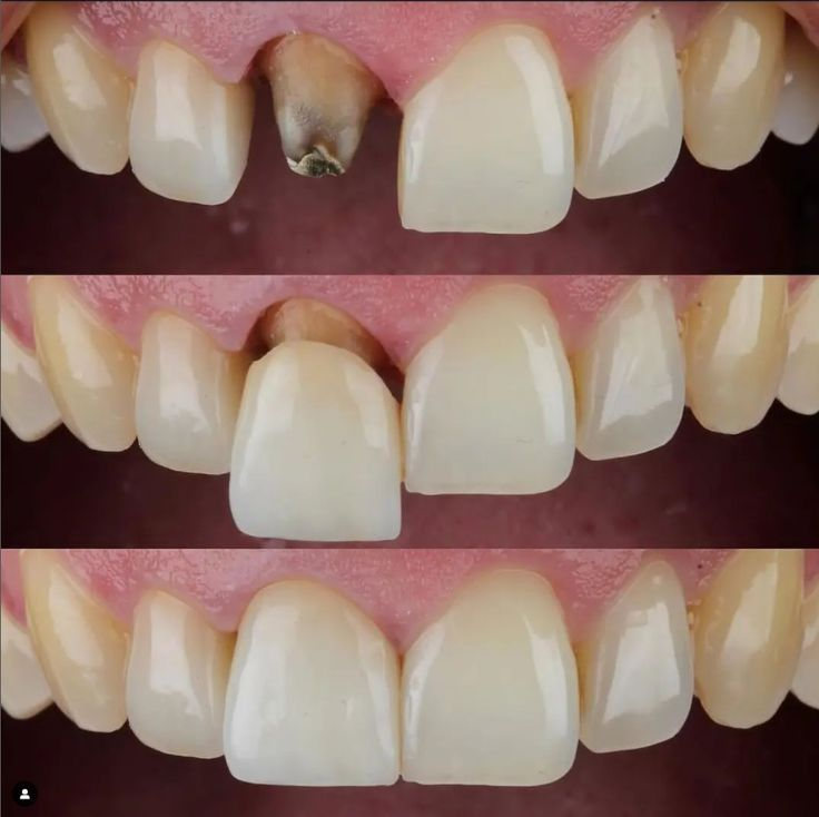 Anterior Full Zirconia — image 1
