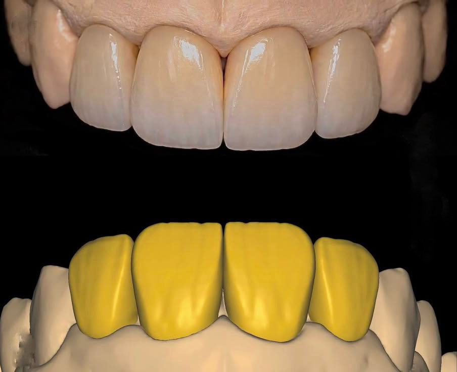 Anterior Full Zirconia — image 2