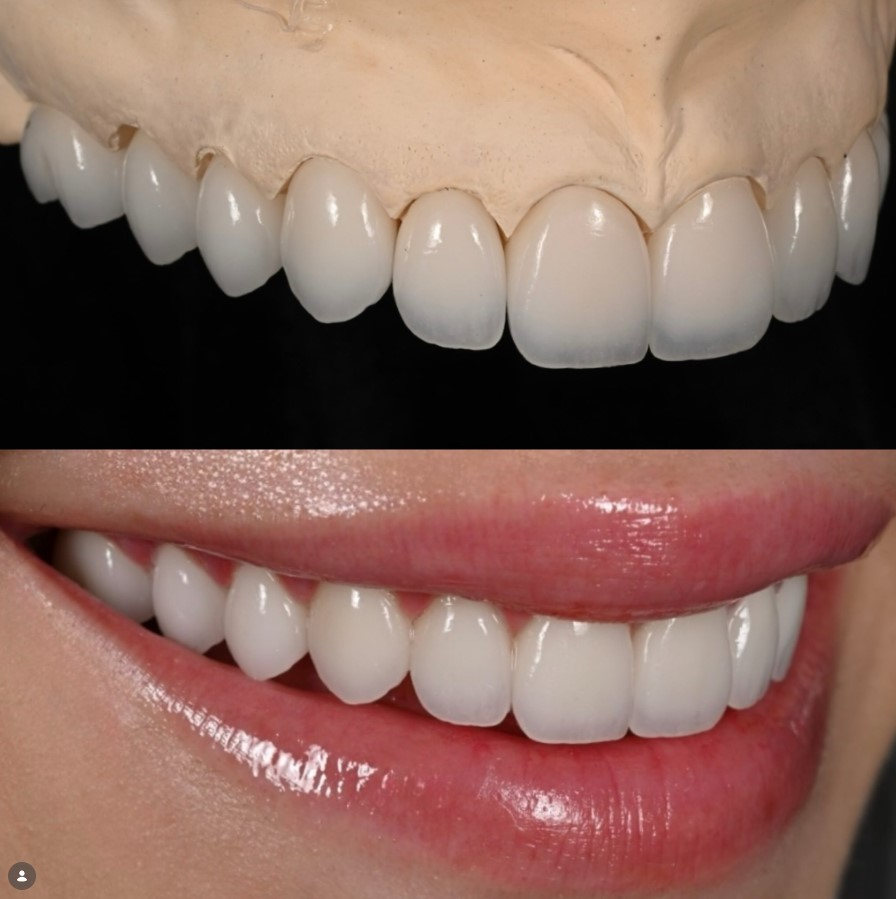 Anterior Full Zirconia — image 3