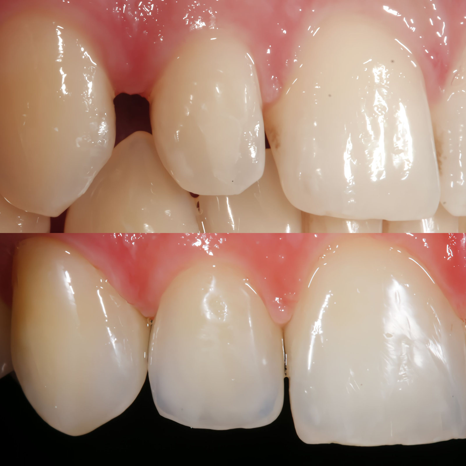 Anterior Full Zirconia — image 4