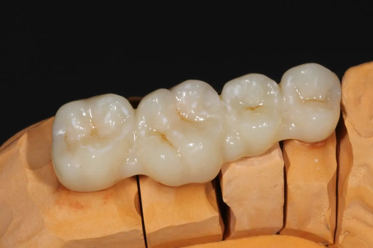 Posterior Full Zirconia — image 1