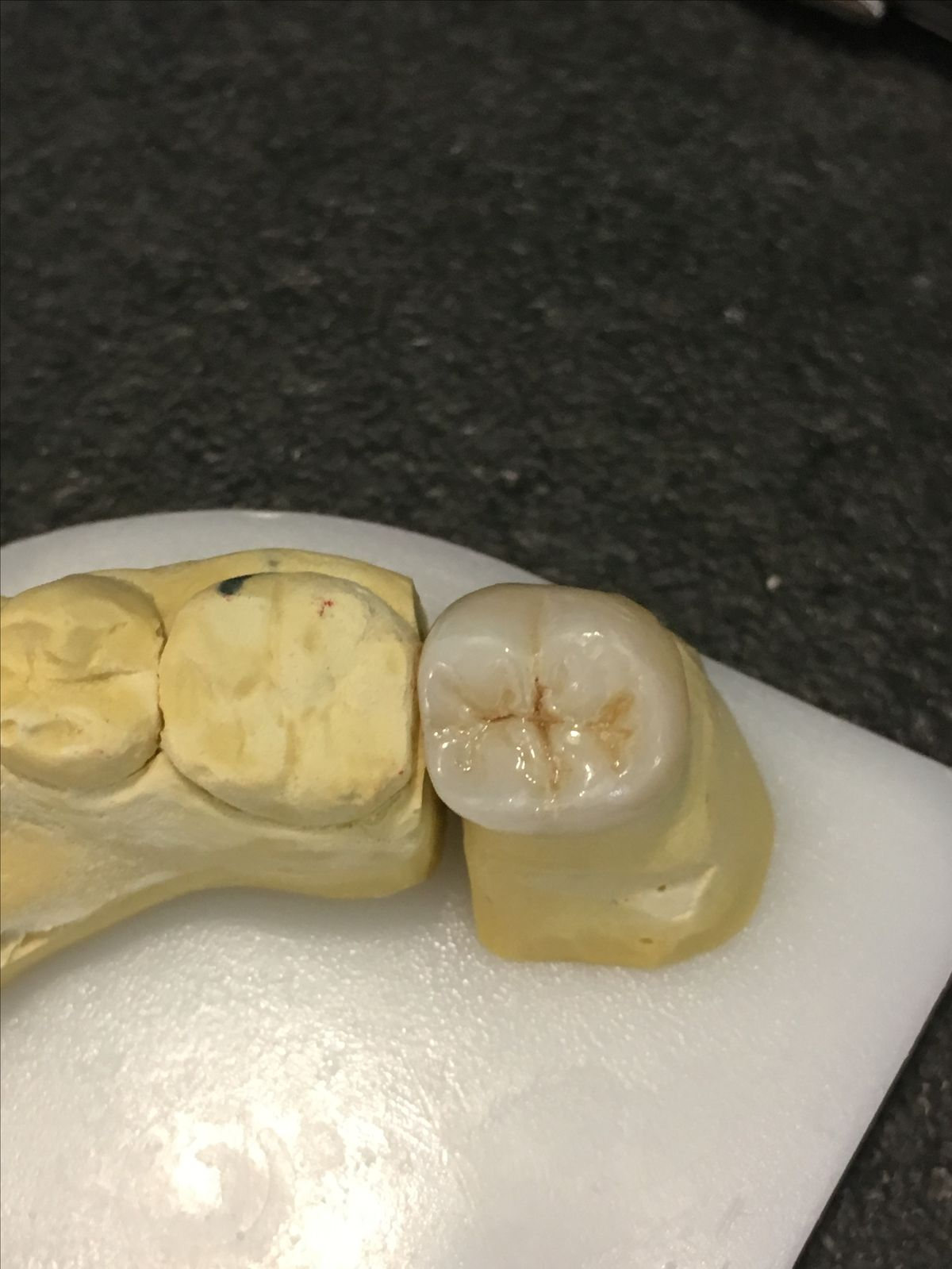Posterior Full Zirconia — image 2
