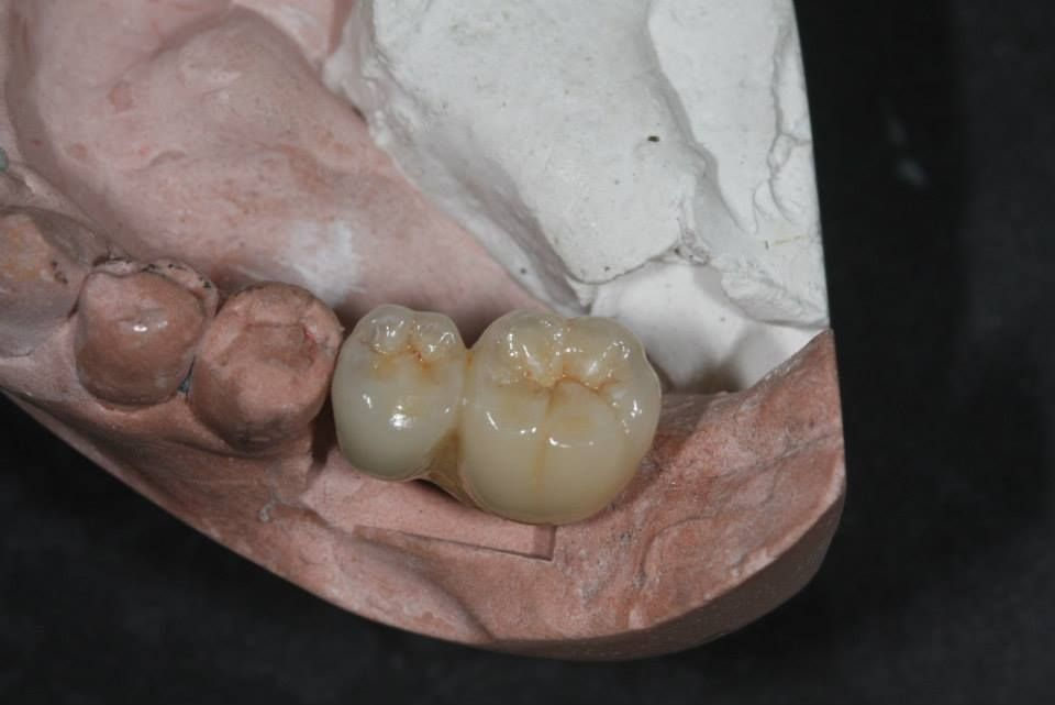 Posterior Full Zirconia — image 3