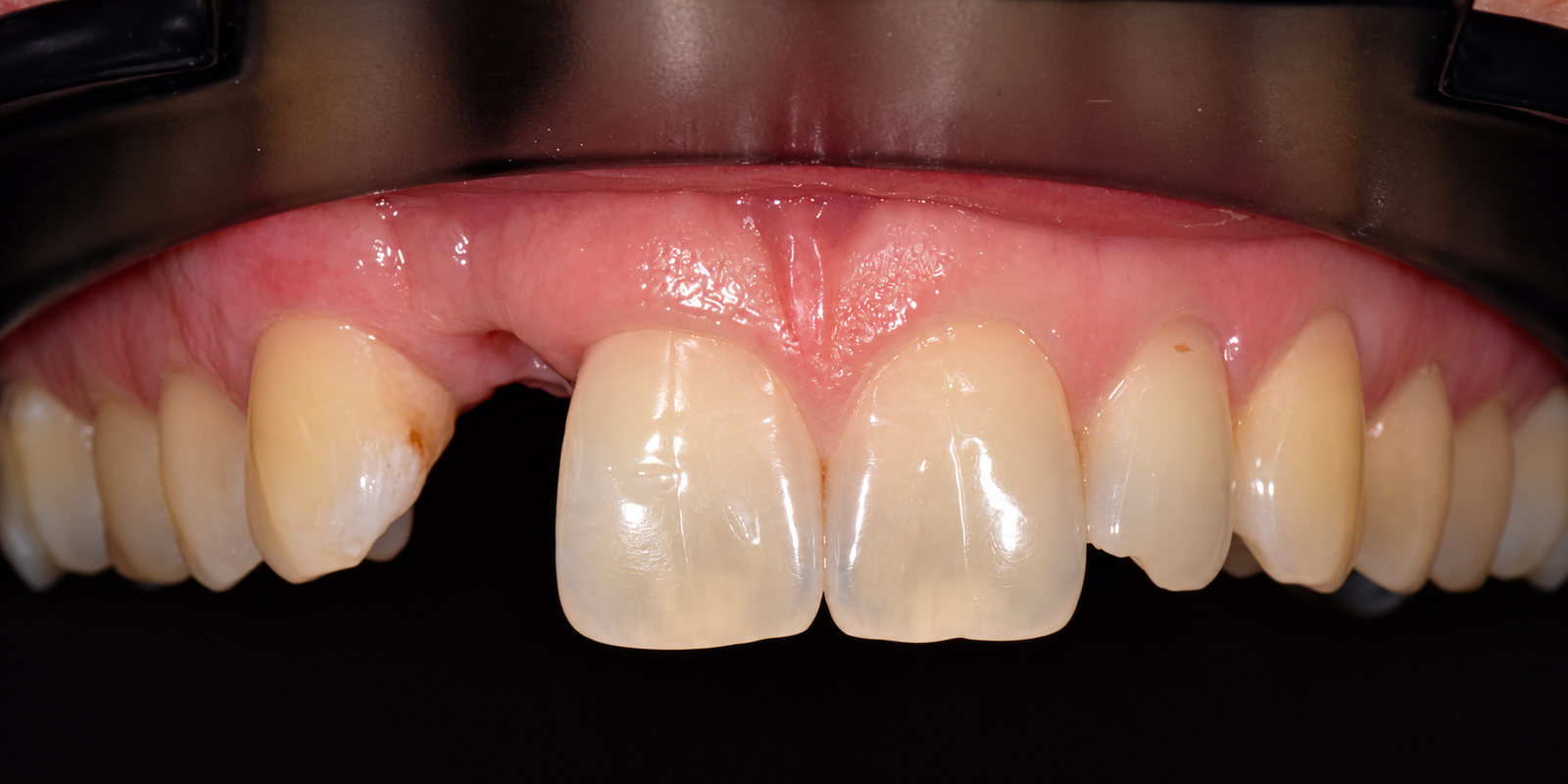CNC Titanium Custom Abutment — Before (1)