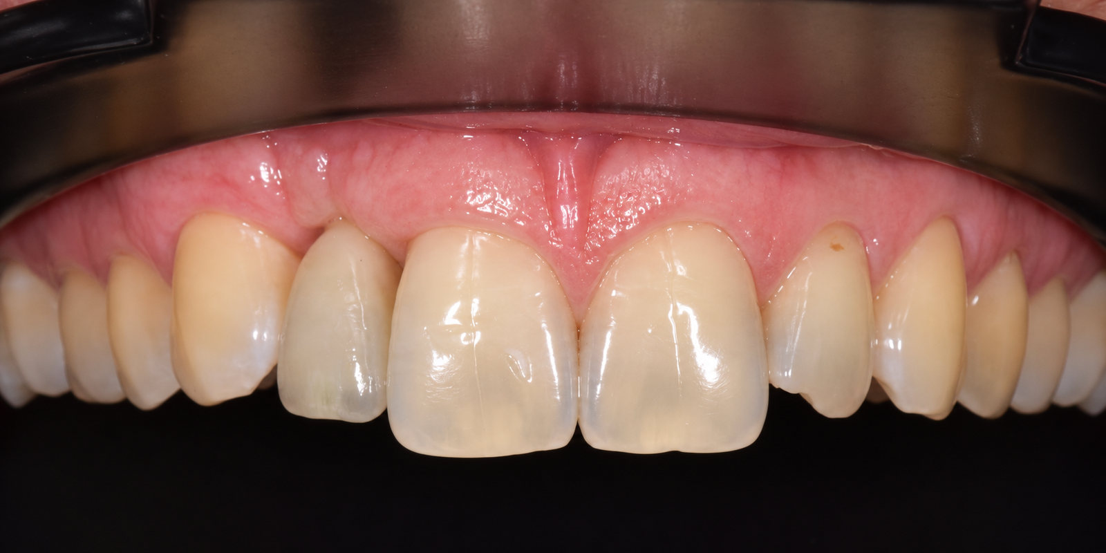 CNC Titanium Custom Abutment — After (1)