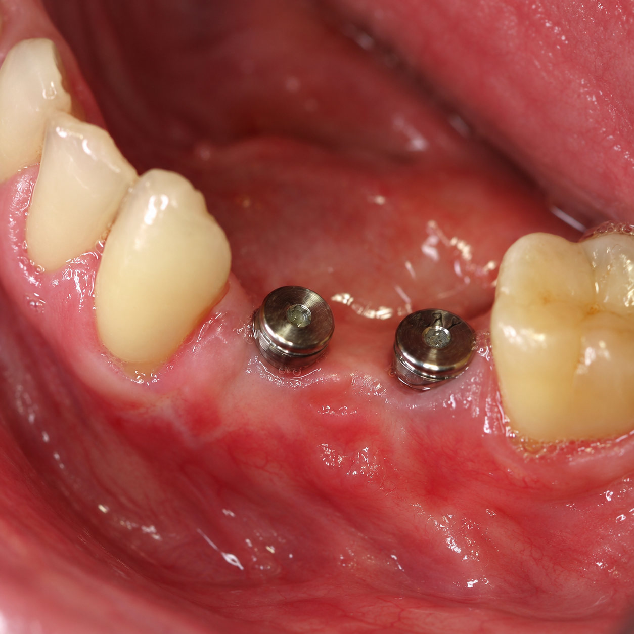CNC Titanium Custom Abutment — Before (2)