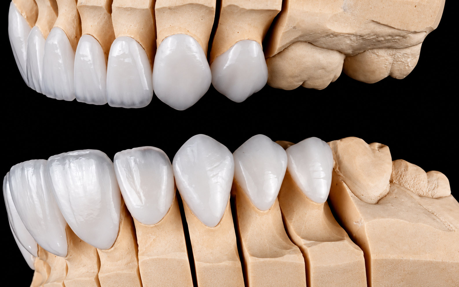 A dental implant and crown set into a jaw model