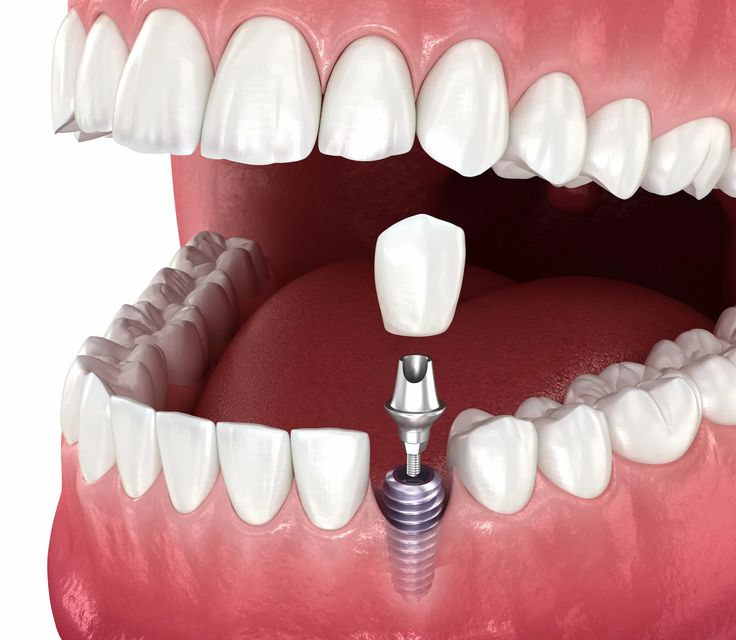 CNC Titanium Custom Abutment — product shot
